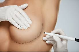 Mamoplastia